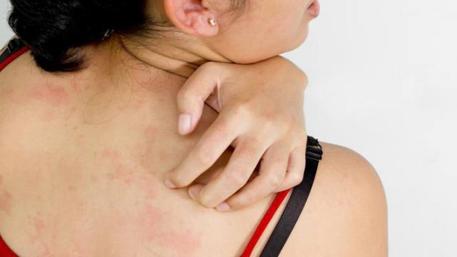 Tắm trắng bằng máy móc và dưỡng chất kém chất lượng gây kích ứng da